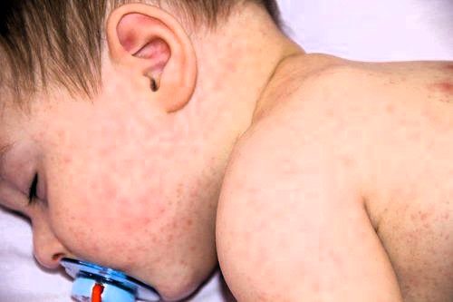 Bé sơ sinh bị rôm sảy quấy khóc vì ngứa ngáy mùa hè