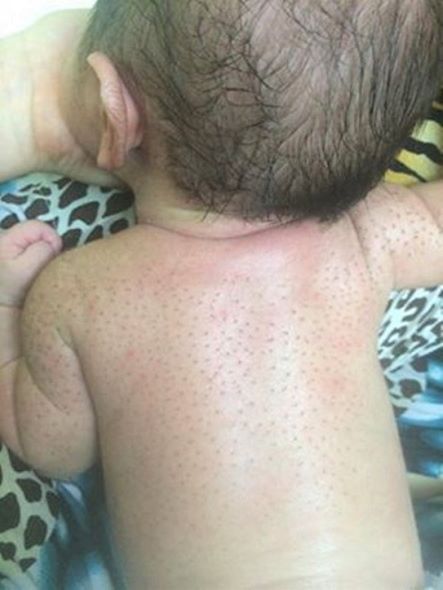 lớp lông tơ mềm mại (lông cáy) trên lưng trẻ sơ sinh